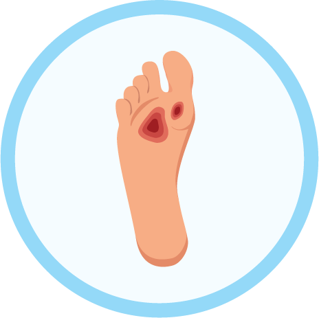 Do you have a current Foot Ulcer which has been present for >1 month ...